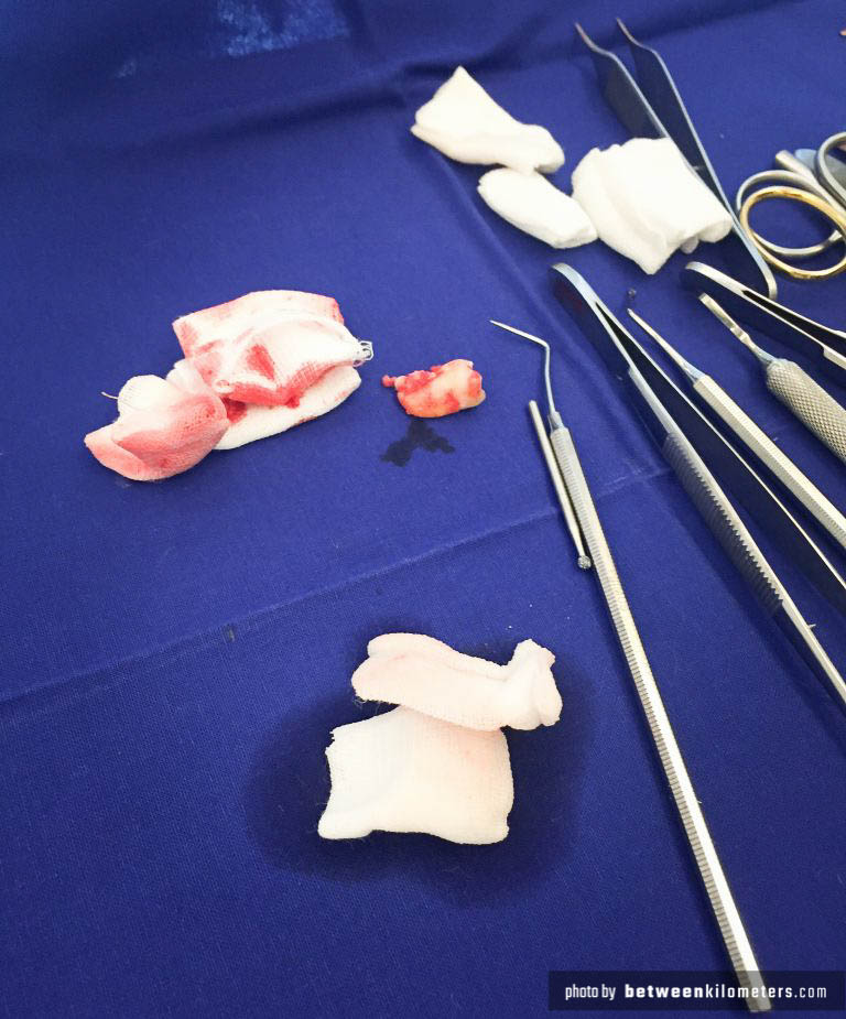 Wyrwany ząb mądrości. Wyrwany ząb mądrości.